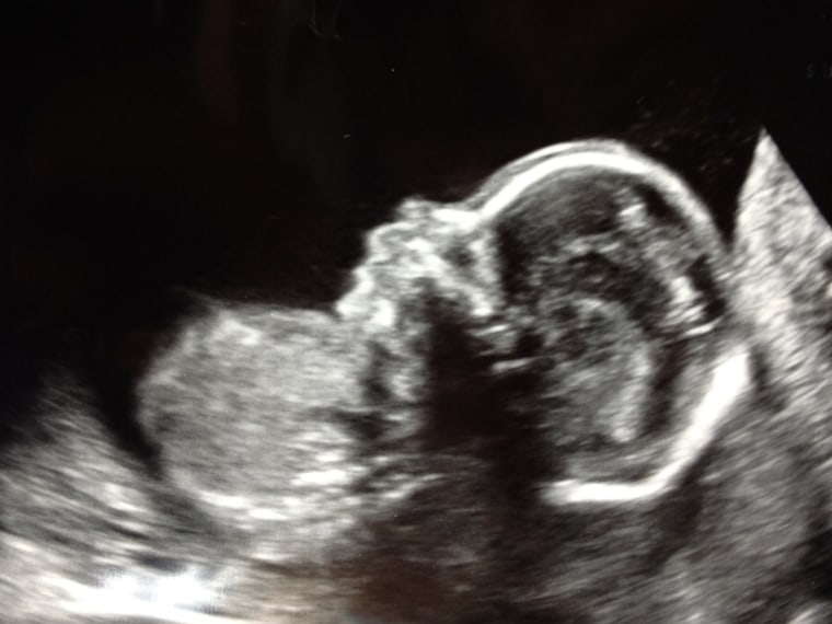 An ultrasound of baby Wolfe-Gosk.