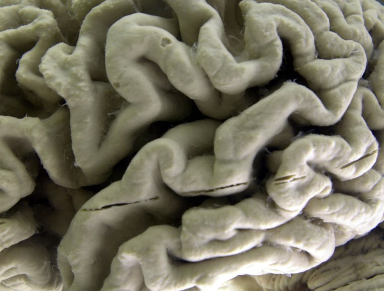 **ADVANCE FOR WEEKEND EDITIONS, NOV. 22-23 ** A section of a human brain with Alzheimer's disease is on display at the Museum of Neuroanatomy at the ...