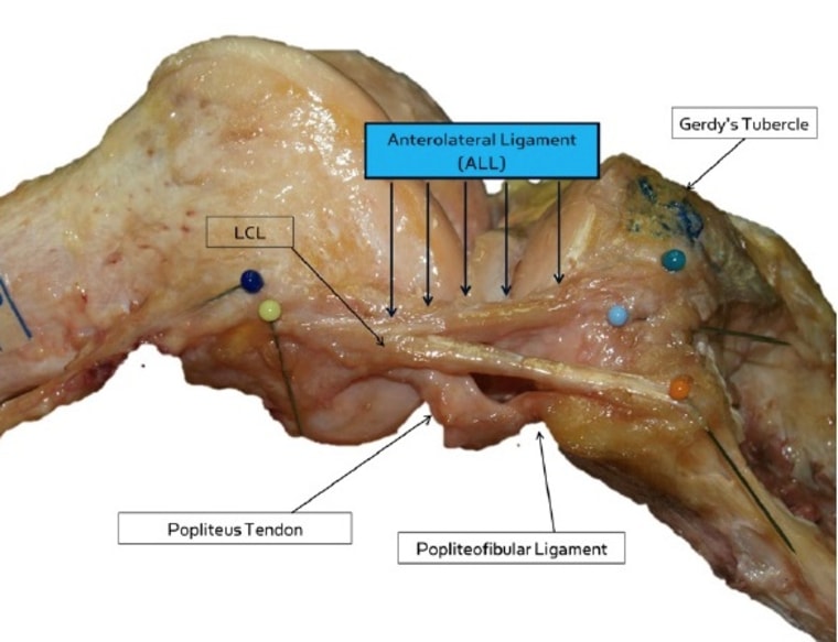 The anterolateral ligament (ALL), a new ligament identified in the human knee.