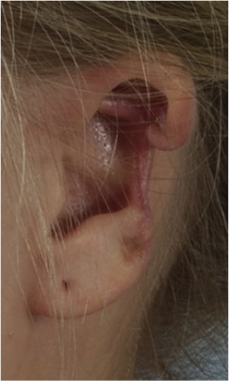 Ear of woman after dead tissue removed