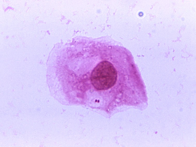 A photomicrograph of Neisseria meningitidis, the bacteria that causes meningitis