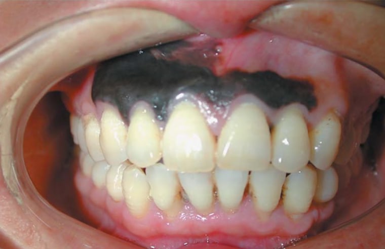 melanoma of the gums
