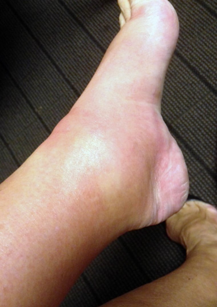 Kathie Lee's swollen foot.
