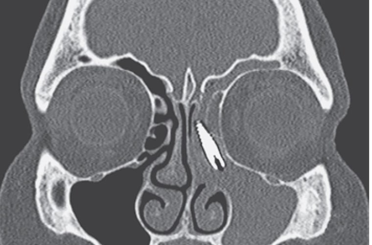 A 57-year-old woman in Italy was found to have a dental implant in her sinus. Above, a CT scan showing the displaced implant.