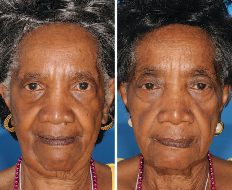 The twin on the left is a nonsmoker and the twin on the right smoked for 29 years. Note the differences in periorbital aging.