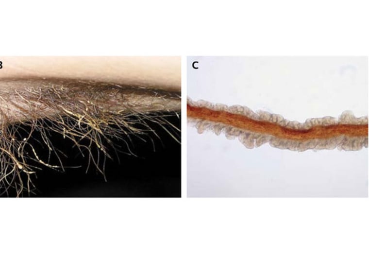 A bacterial infection of armpit hair was the cause of one man's body odor. Above, infected armpit hair (right) and view of hair under a microscope (left).