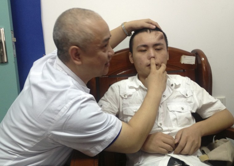 A doctor checks the infected and deformed nose of Xiaolian, before replacing it with a new nose, grown by surgeons on his forehead, at a hospital in F...
