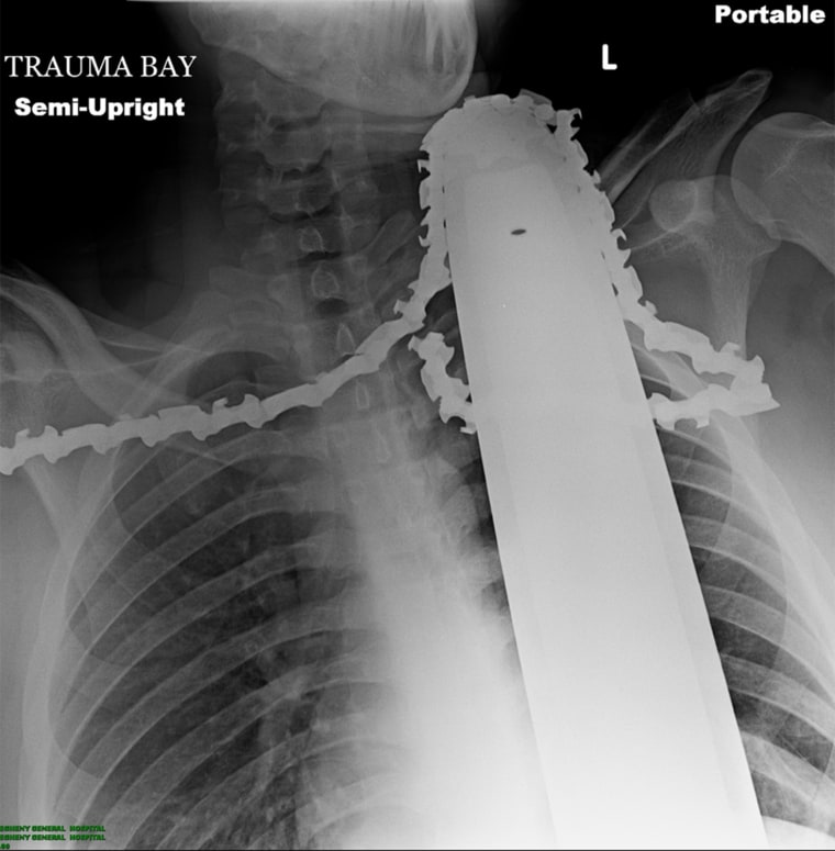 Image: James Valentine was taken to Allegheny General Hospital in Pittsburgh on Monday, where this X-ray was taken that shows the chainsaw stuck in his neck.