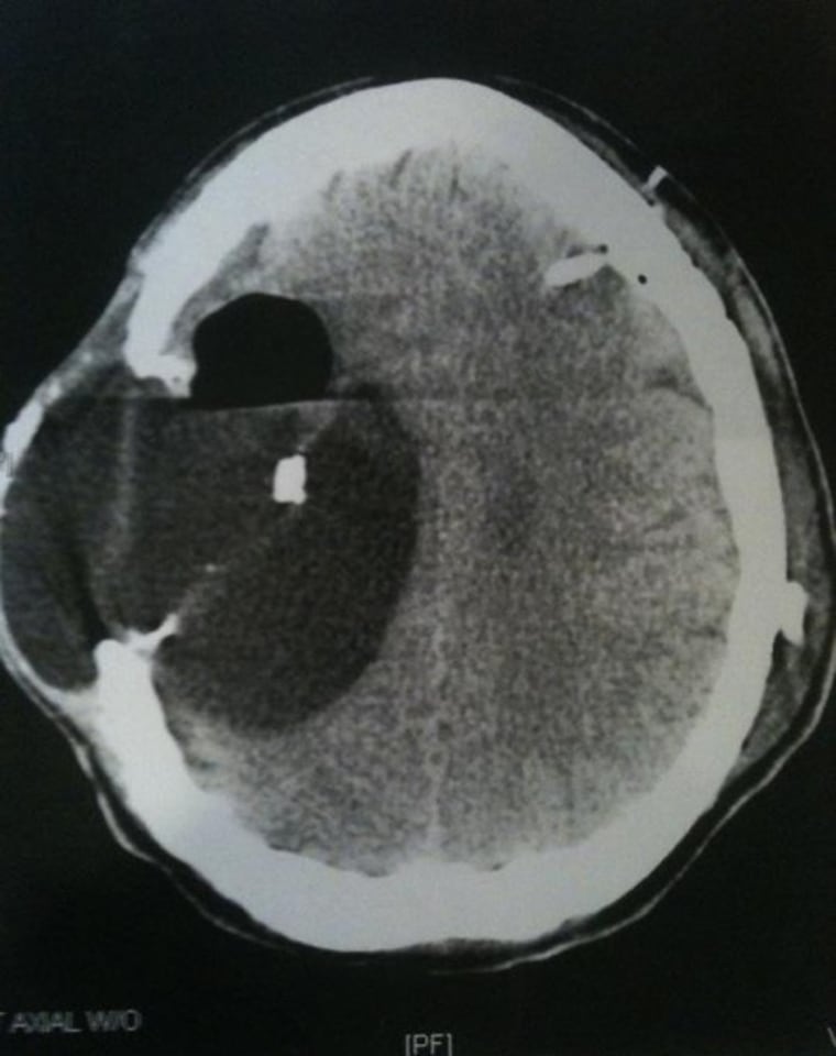 This  xray shows Patrick Zeigler's brain after a bullet entered it. He had to have 20 percent of his brain removed.