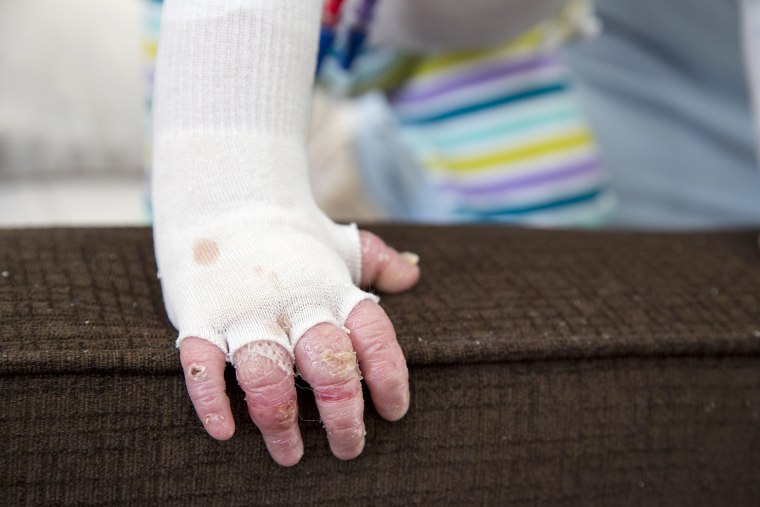 17-month-old Elisa McCann is living with Epidermolysis Bullosa, a rare and debilitating skin disease. Her condition has been rapidly improving after s...