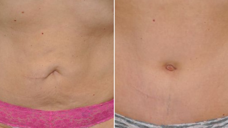 Tummy Tuck Belly Button: Art of Aesthetics