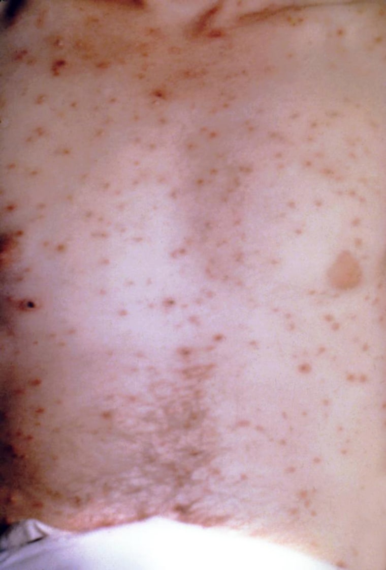 Chickenpox patients can develop anywhere from 250 to 500 little blisters.