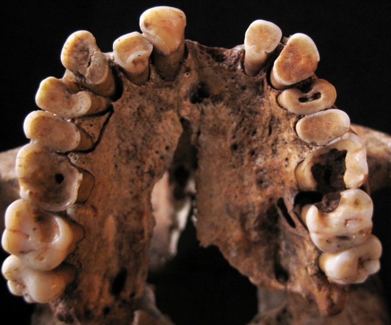 Image of cavity filled teeth from Taforalt