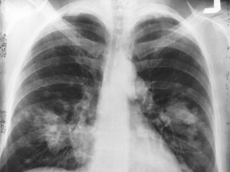 This is an x-ray image of a chest. Both sides of the lungs are visible with a growth on the left side of the lung, which could possibly be lung cancer...