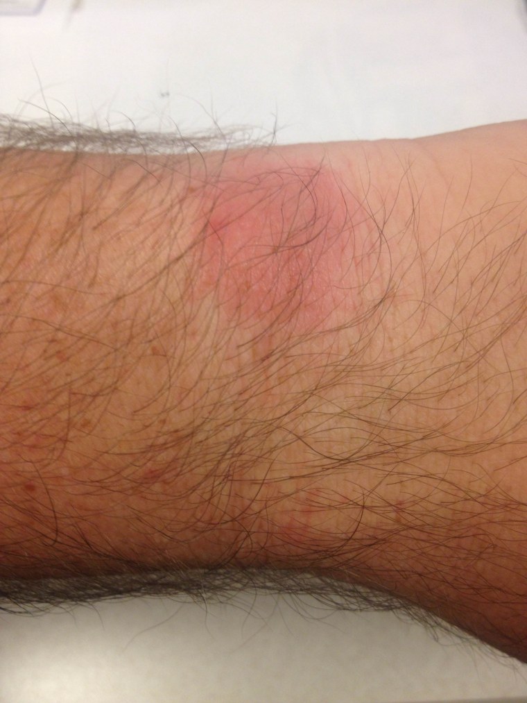 Fitbit rash