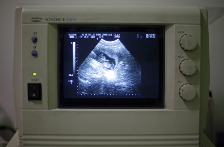 A three-month-old fetus appears on a screen during an ultrasound exam.