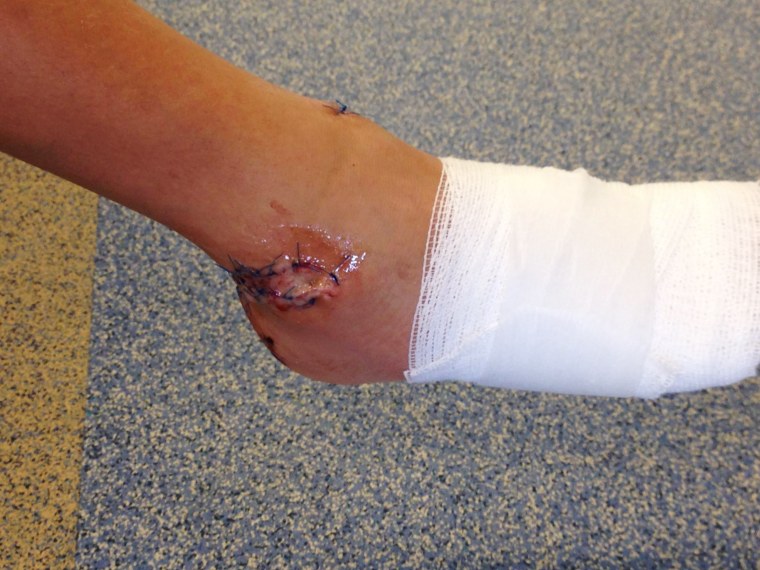 Sebastian Cozzan's wound after he was bitten by a shark on March 21 in North Palm Beach, Fla. He received 80 stiches.