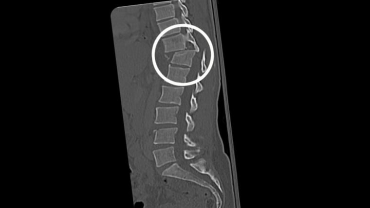 The x-ray showing Amy's severed spine.