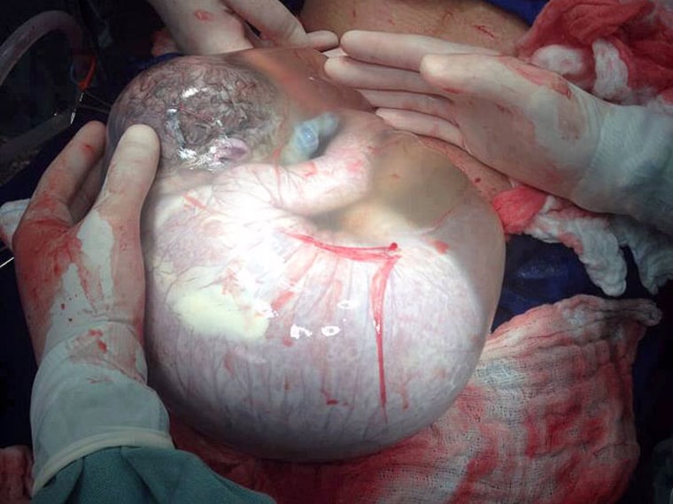 Rare Photo Shows Baby in Amniotic Sac During Childbirth