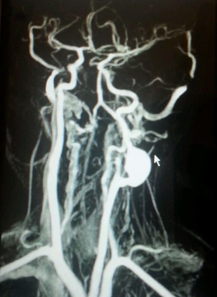 An image of the golf ball-size aneurysm doctors found in Tashawn.