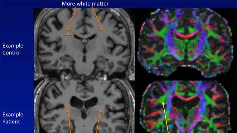 Brain scans showing the brain of someone with chronic fatigue compared to a control brain