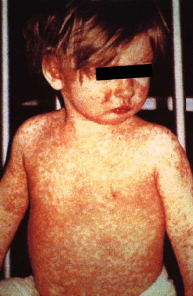This child has a classic measles rash