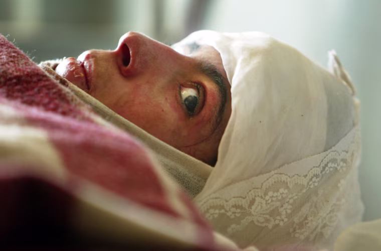 Desperation Drives Women To Self Immolation In Herat