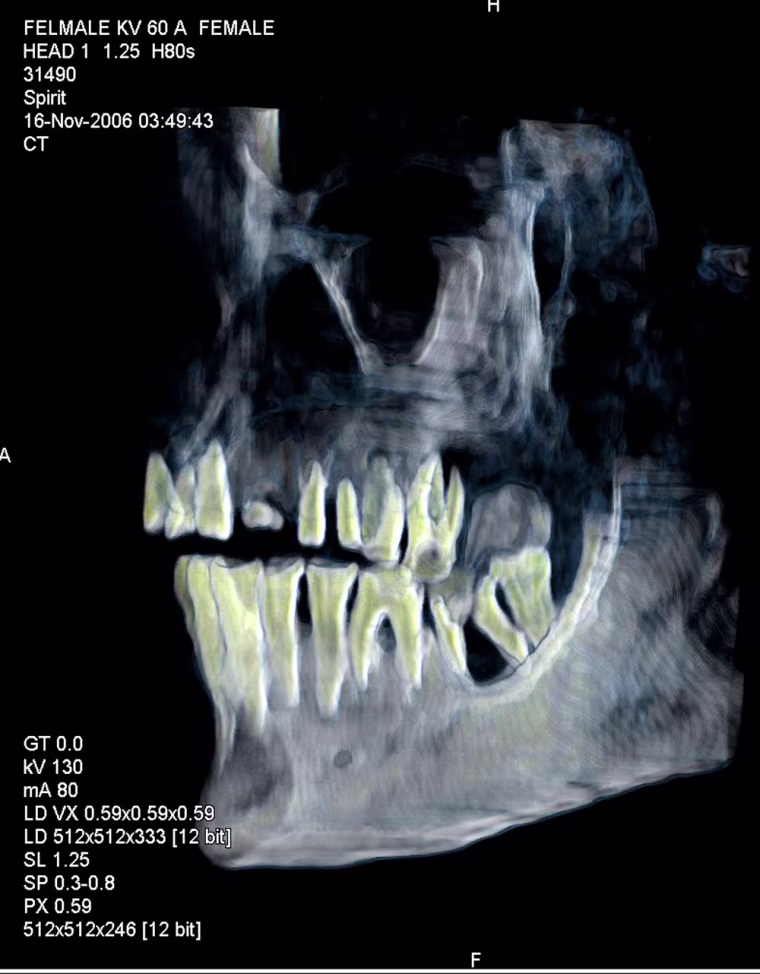 This recent, undated photo released Wednesday June 27, 2007 by Discovery Channel shows an X ray image of the mummy of Pharaoh Queen Hatshepsut at the Egyptian museum in Cairo, Egypt.  Egyptian authorities using DNA from a tooth identified Wednesday a mummy found a century ago as the remains of pharaoh Queen Hatshepsut. The mummy was discovered in Egypt's Valley of the Kings burial ground in 1903, but had not been identified as that of the queen and was left on site until two months ago when it was brought to the Cairo Museum for testing, said Egypt's antiquities chief Zahi Hawass.  (AP Photo/Discovery Channel /HO)
