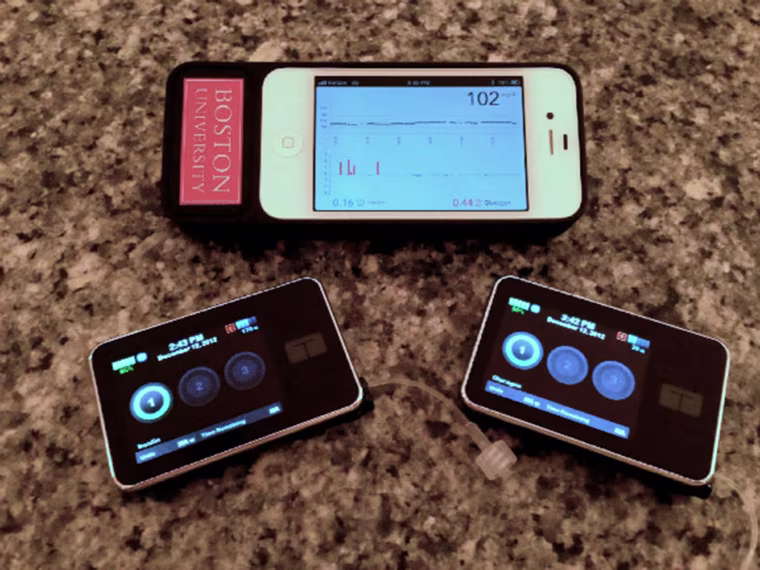 The bionic pancreas developed by a Boston University/Massachusetts General Hospital research team consists of a smartphone hardwired to a continuous glucose monitor and two pumps that deliver doses of insulin or glucagon every five minutes.