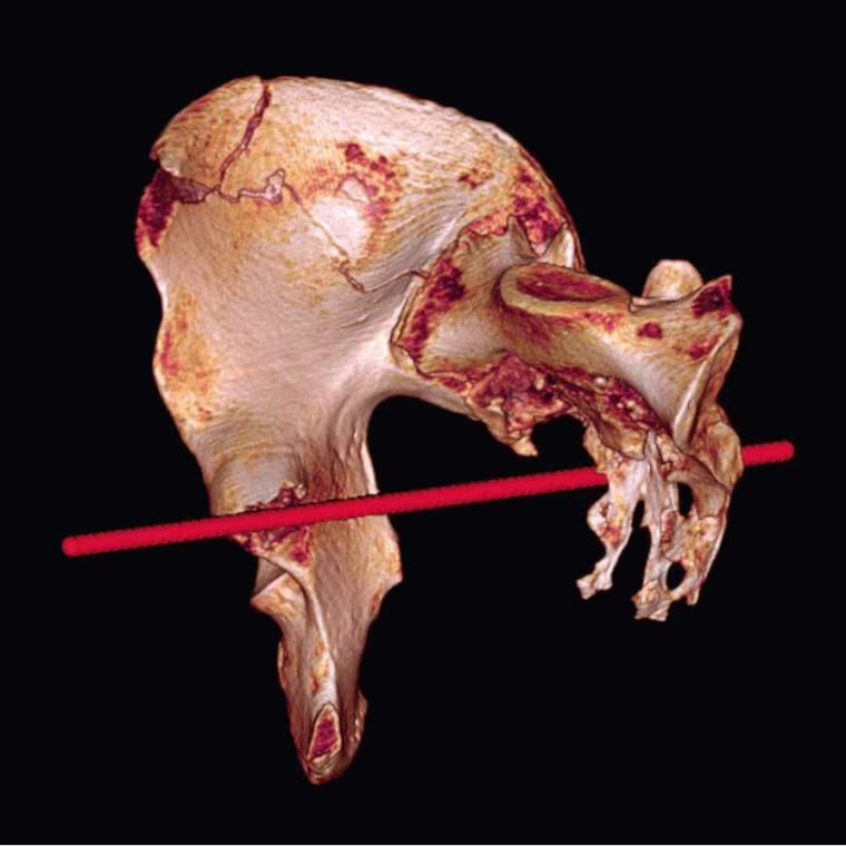 Image: Pelvis wound