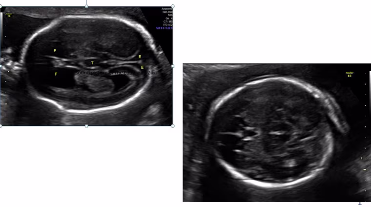 Image: Zika effects on fetus