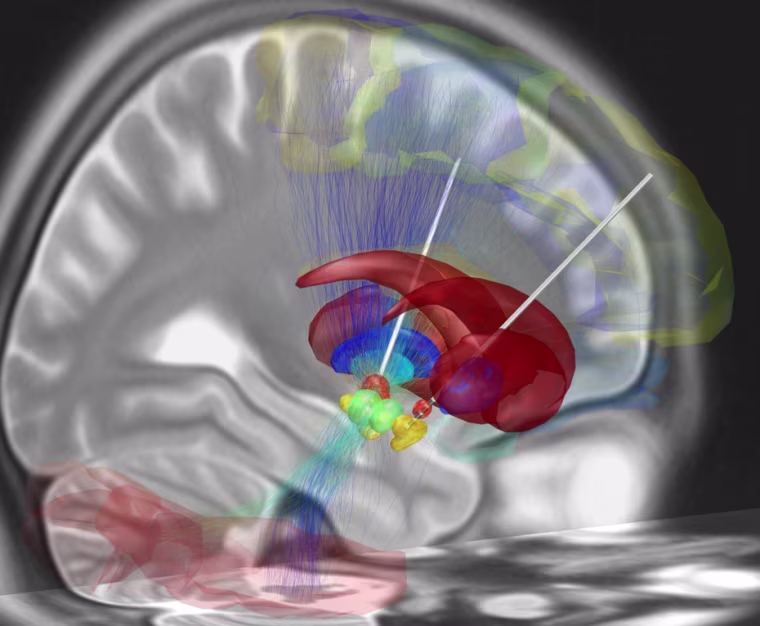 A reconstruction of deep brain stimulation depicts electrodes that have been surgically placed into the most common target structure for treatment of Parkinson's disease, the subthalamic nucleus (orange). The STN is part of the brain's stopping system and is a particular focus of this study.