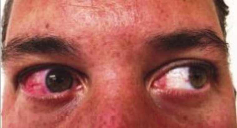 A 44-year-old man developed a painful rash when he became infected with Zika virus in Puerto Rico.