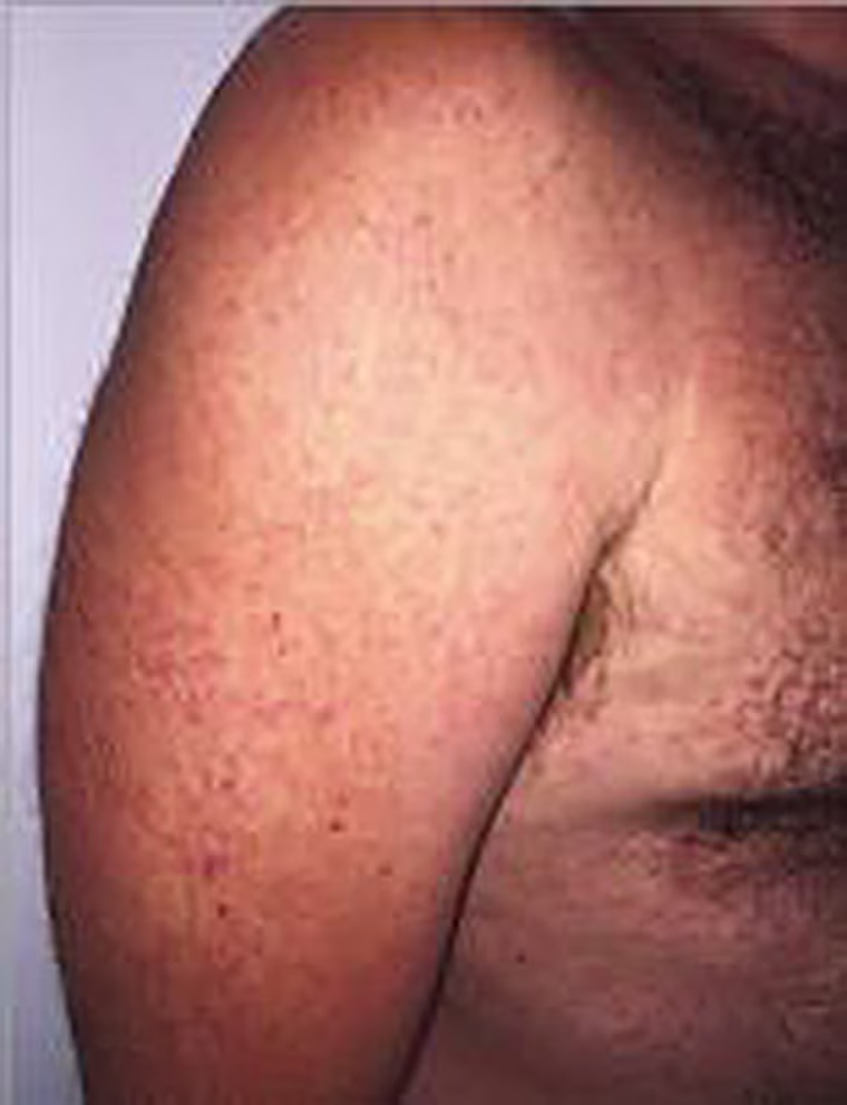 This is what a Zika rash looks like.
