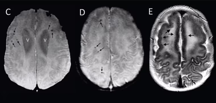 Assessment of a Series of 13 Infants with Congenital Zika Virus Infection without Microcephaly at Birth.