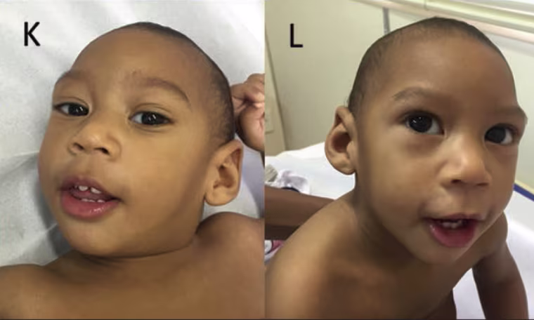 Assessment of a Series of 13 Infants with Congenital Zika Virus Infection without Microcephaly at Birth