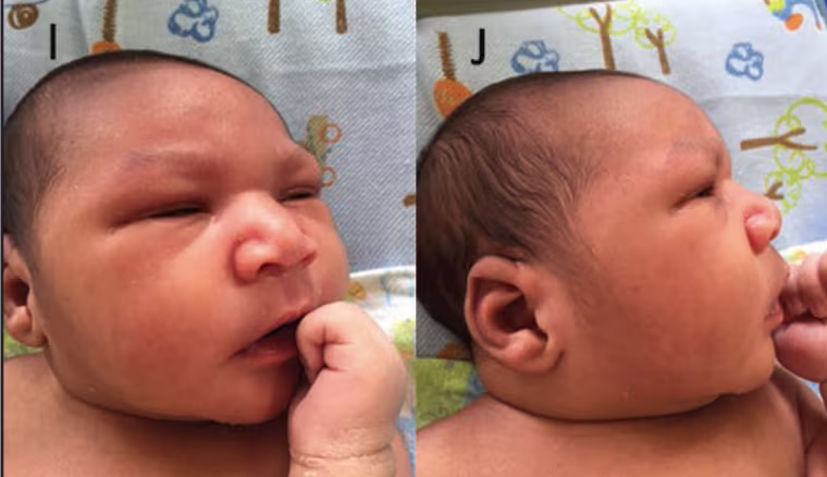 Assessment of a Series of 13 Infants with Congenital Zika Virus Infection without Microcephaly at Birth