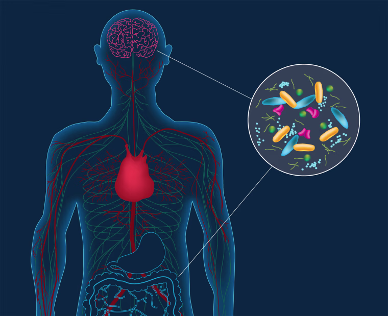 Artist's concept depicting microbes in the gut instigating changes in the brain that can lead to Parkinson's disease. People with Parkinson's harbor distinct gut bacteria that influence the disease's severity.