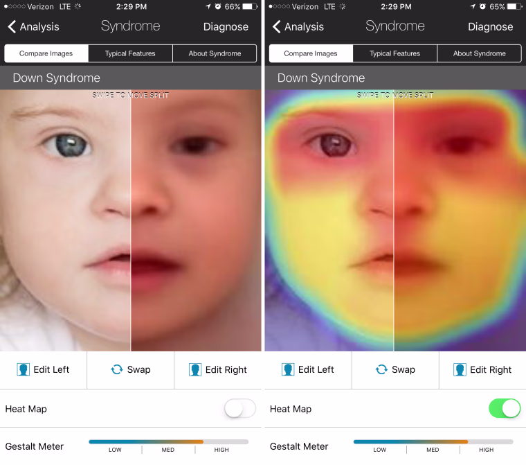 Image: Facial recognition app Face2Gene is being used by doctors to diagnose rare diseases