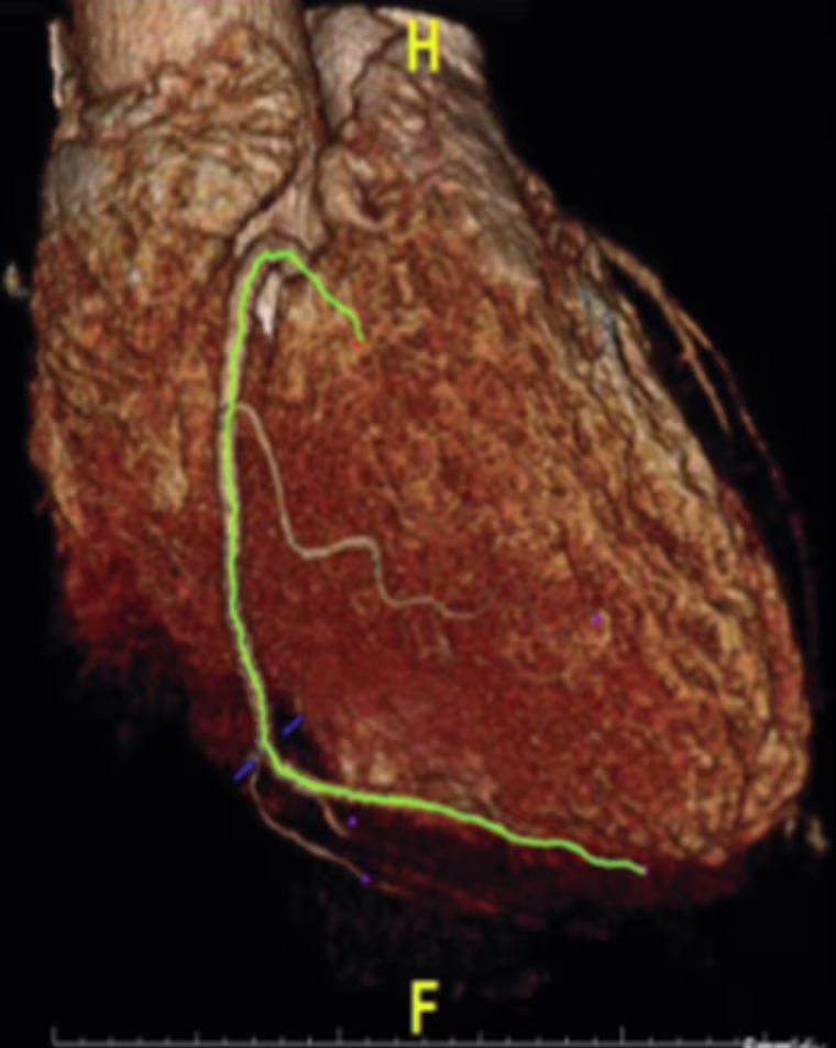 A newly developed imaging method identifies inflamed artery lesions that pose the most risk to patients.