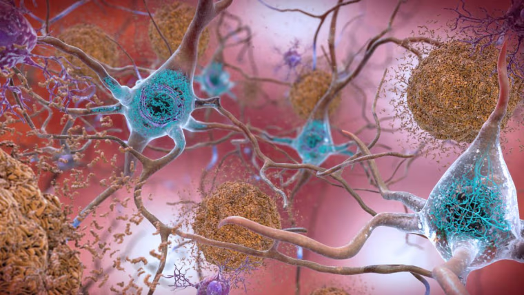 A new study projects that 46.7 million Americans have evidence they are at risk of Alzheimer's