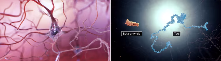 Image: Alzheimer's