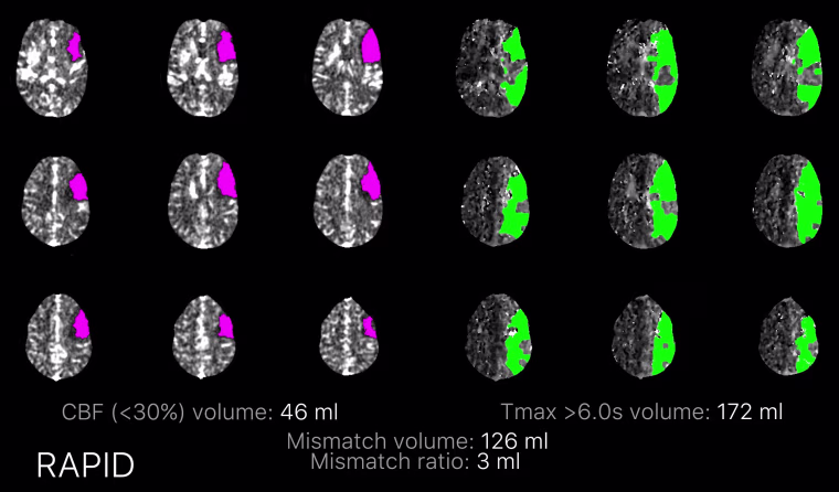 Image: Stroke CT perfusion scan
