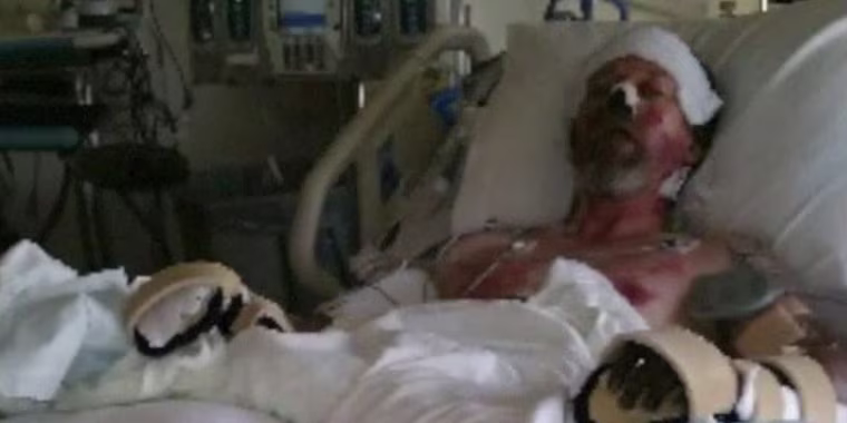 West Bend lost both hands and both lower legs to amputation to save his life.