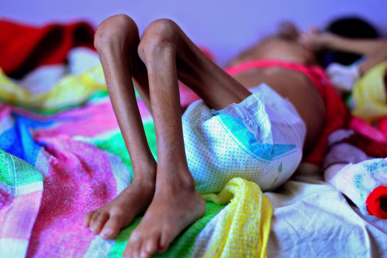 A Yemeni child suffering from malnutrition lies on a bed at a treatment center in a hospital in the capital Sanaa on Oct. 6, 2018