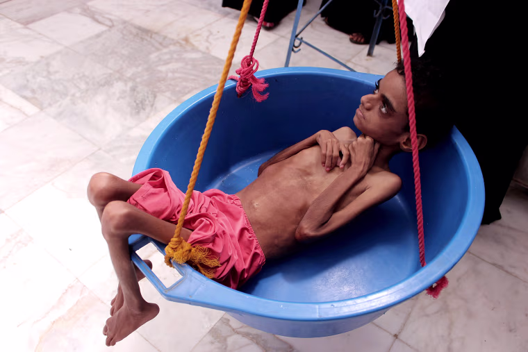 Image: TOPSHOT-YEMEN-CONFLICT-MALNUTRITION