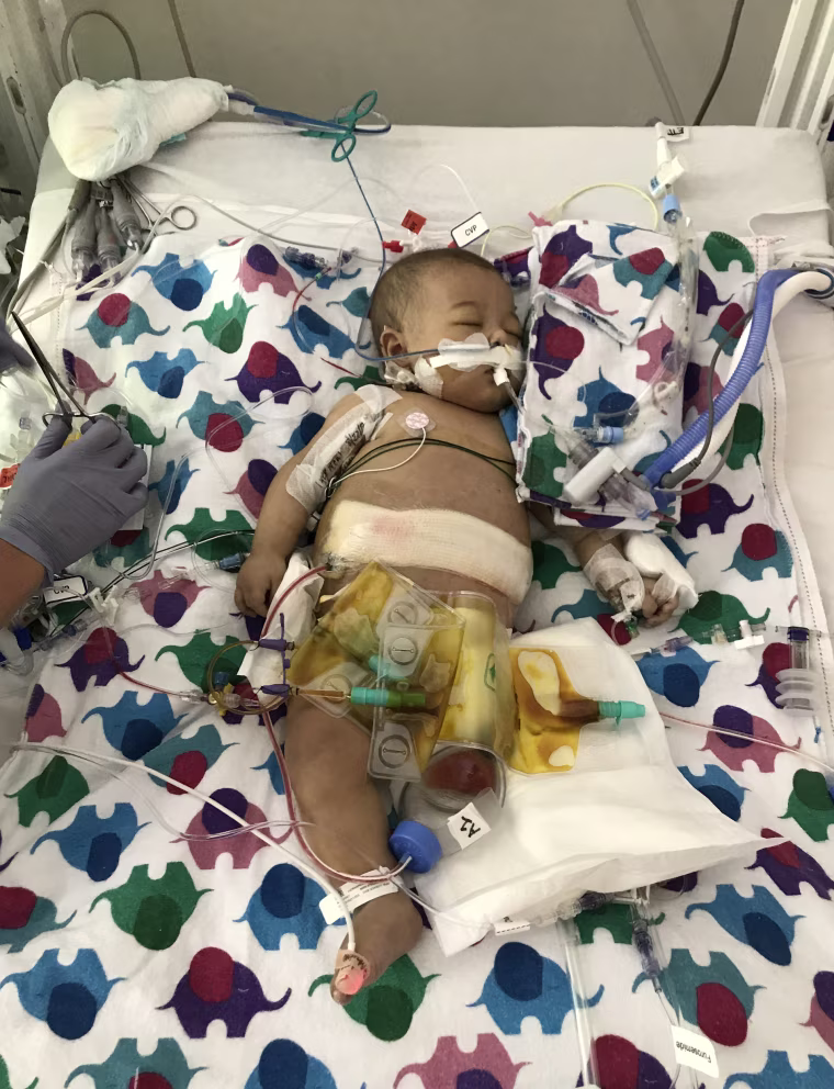Image: Noah the day after his transplant.