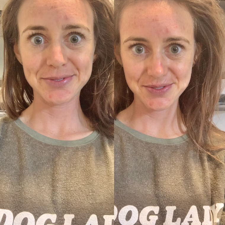Before (left) and after (right) using the Kate Somerville ExfoliKate Intensive Pore Exfoliating Treatment