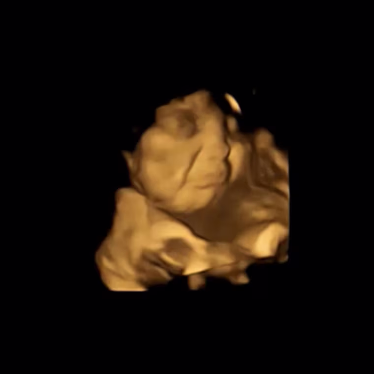 An image from the FETAP (Fetal Taste Preferences) study showing a grimacing reaction to kale flavor.
