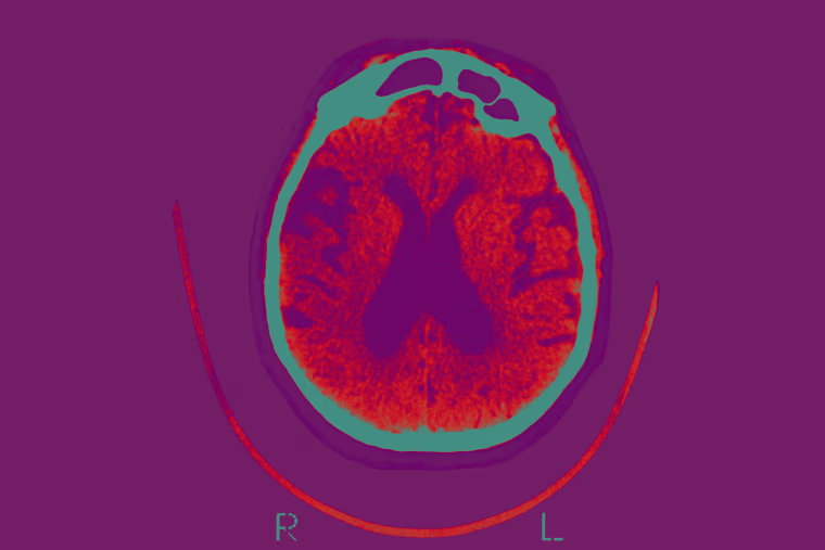 Axial Section scan of the brain of a patient affected By Alzheimer's.